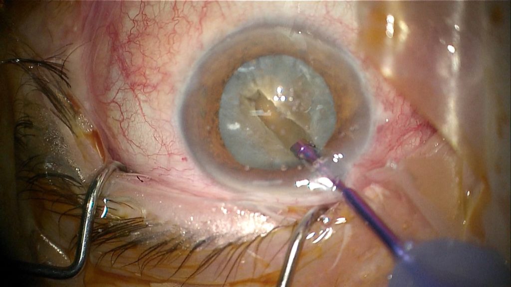 Cataracte vue per-op - aspiration de la cataracte