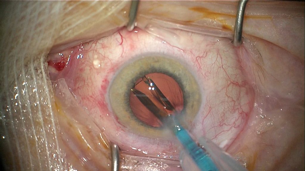 Cataracte vue per-op - implantation du cristallin artificiel
