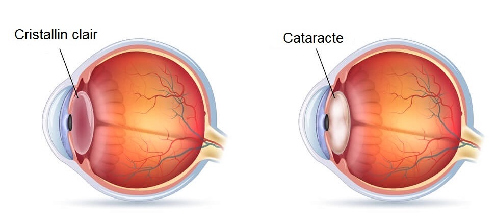 Schéma cataracte